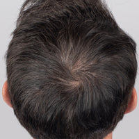 Back of man's head at week 12 after his Nulastin hair renewal journey