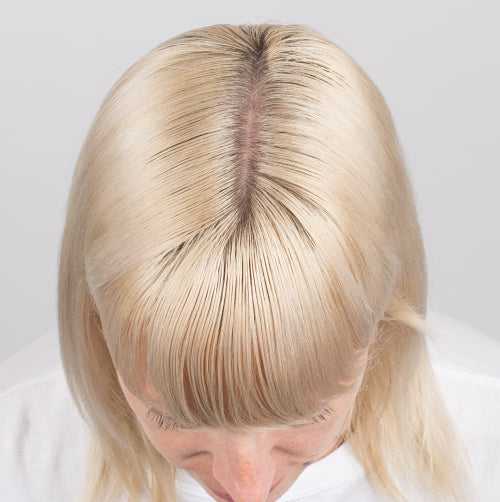 Top of woman's head with visible hair loss after starting scalp treatment