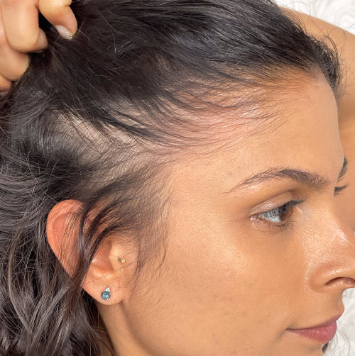 Side view of woman's head with thinning hair before using Nulastin hair serum
