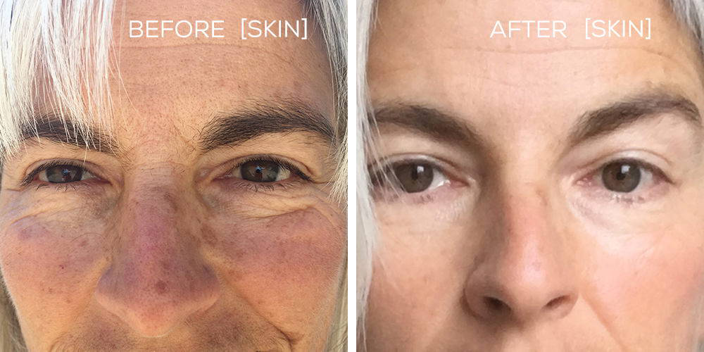 Split close-up of a woman's face showing sun damage before and after; left reads BEFORE SKIN, right reads AFTER SKIN