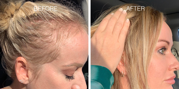 Side-by-side before and after photos of a woman’s scalp: left labeled BEFORE shows a thinning hairline; right labeled AFTER shows fuller hair held back by hand