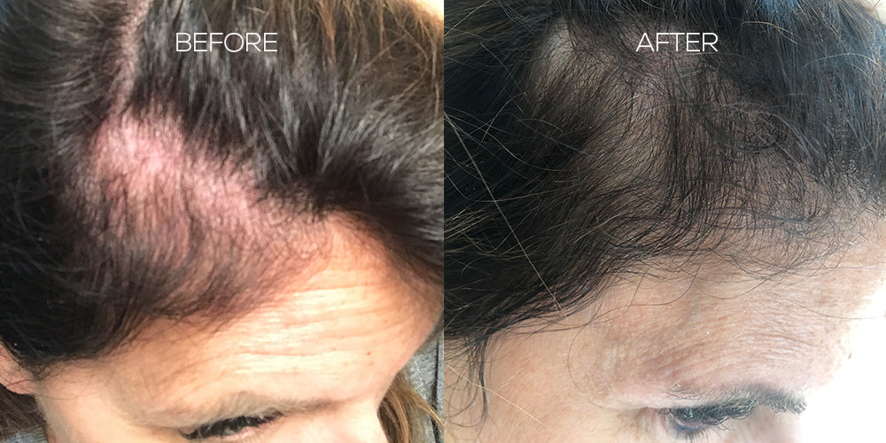 Split view of woman's scalp labeled BEFORE and AFTER, left with thinning hair, right with fuller hair after treatment