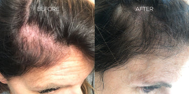 Split view of woman's scalp labeled BEFORE and AFTER, left with thinning hair, right with fuller hair after treatment