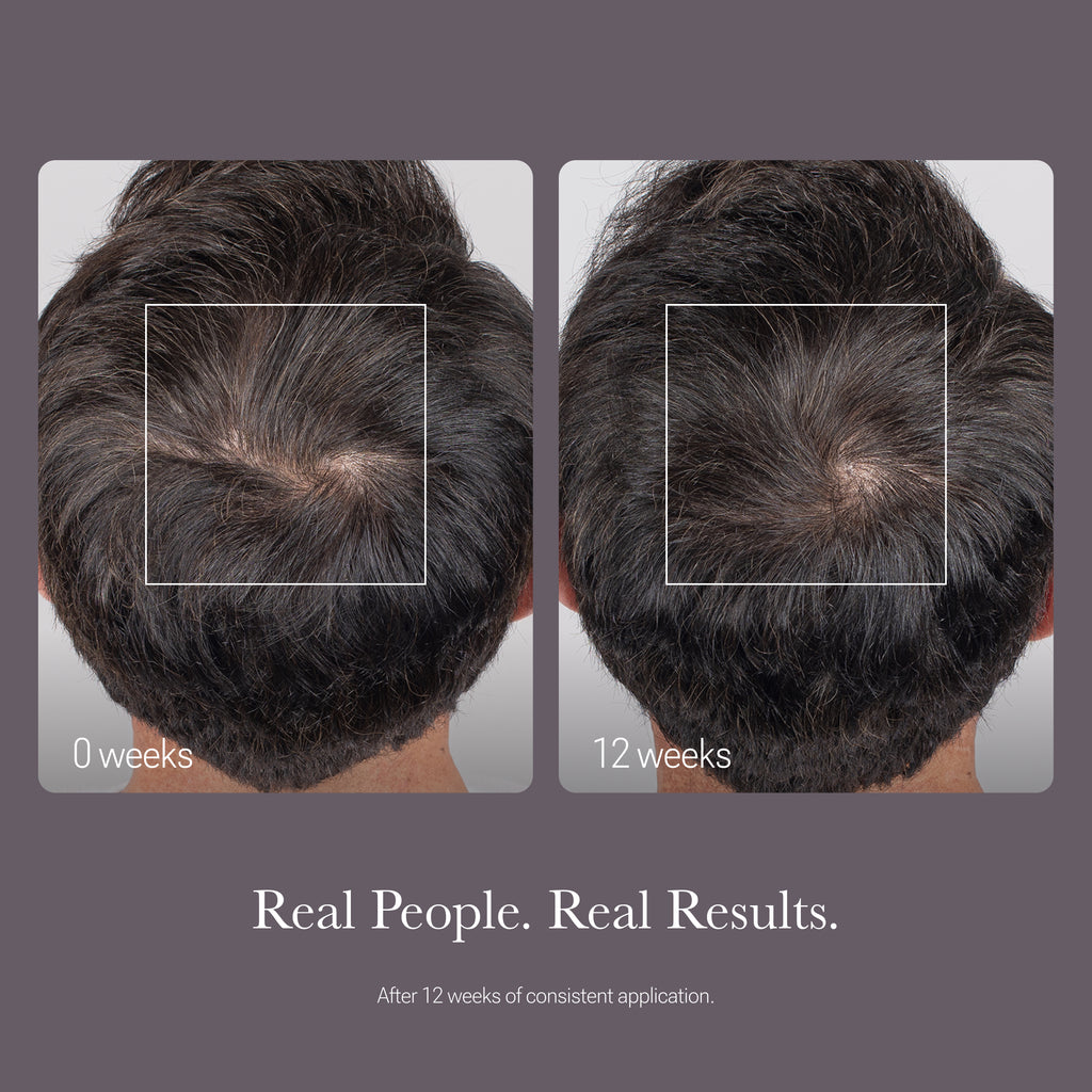 Before and after photos of a man’s head after using Scalp Treatment for 12 weeks
