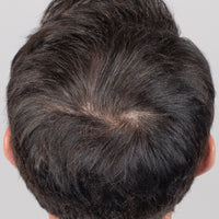 Back of man's head at week 0 before his Nulastin hair renewal journey