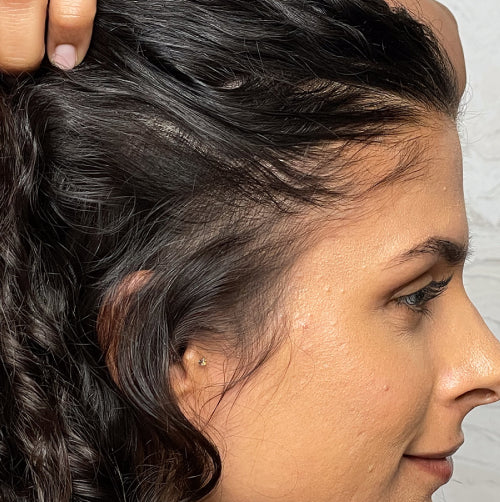 Side view of woman's head with thinning hair after using Nulastin hair serum